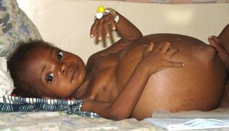  Nephrotic_Syndrome (10).jpg